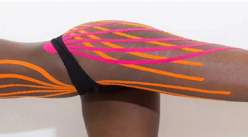 Тейпирование растяжек Тейпирование растяжек